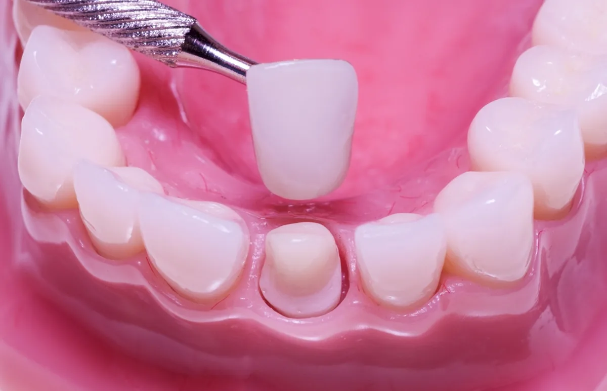 Do I Need a Dental Crown? | Woodland, CA