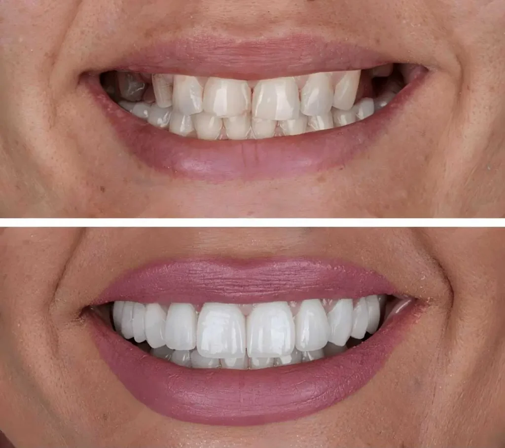 dental implants in springlake dental