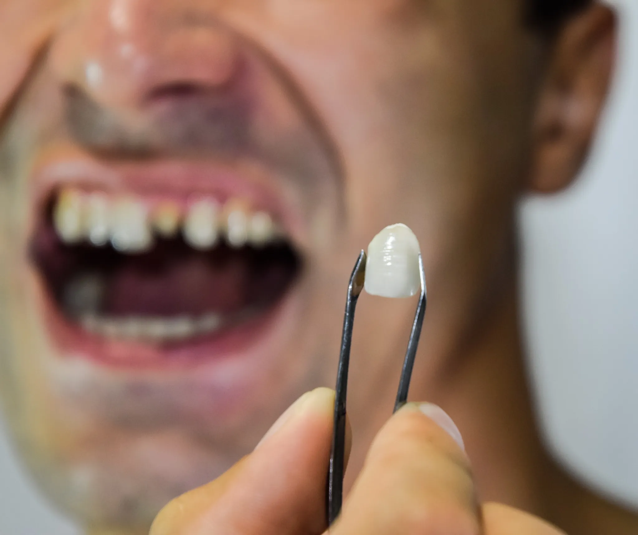 Close-up of a dental veneer held with tweezers before tooth extraction – SpringLake Dental Woodland, CA