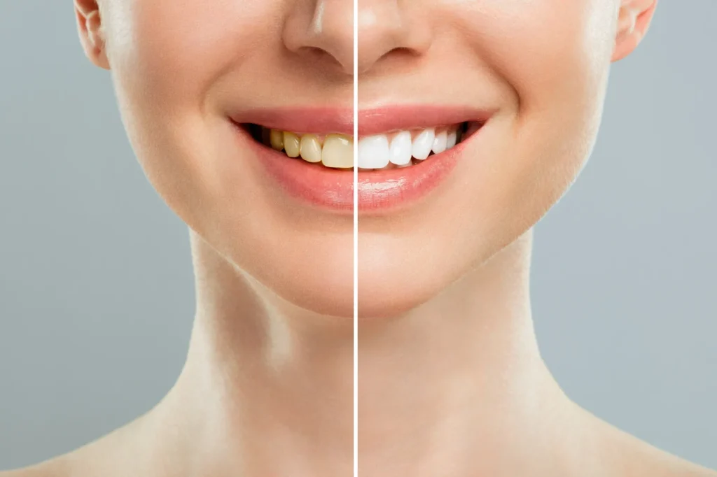 Before and after teeth cleaning results at a dental clinic in Woodland, CA