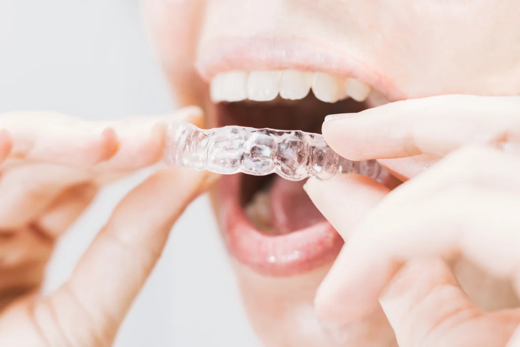 Patient showing Invisalign clear aligners at Springlake Dental in Woodland CA