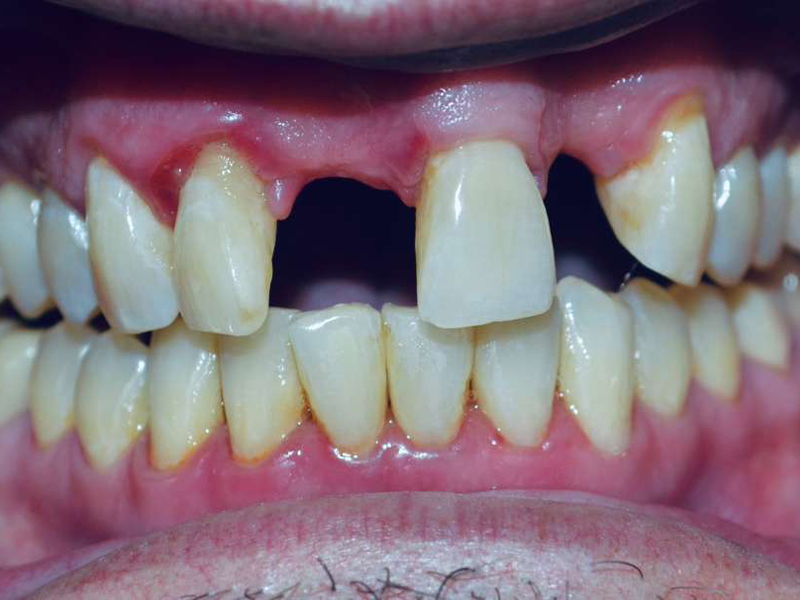 Before and after dental implants at SpringLake Dental in Woodland CA